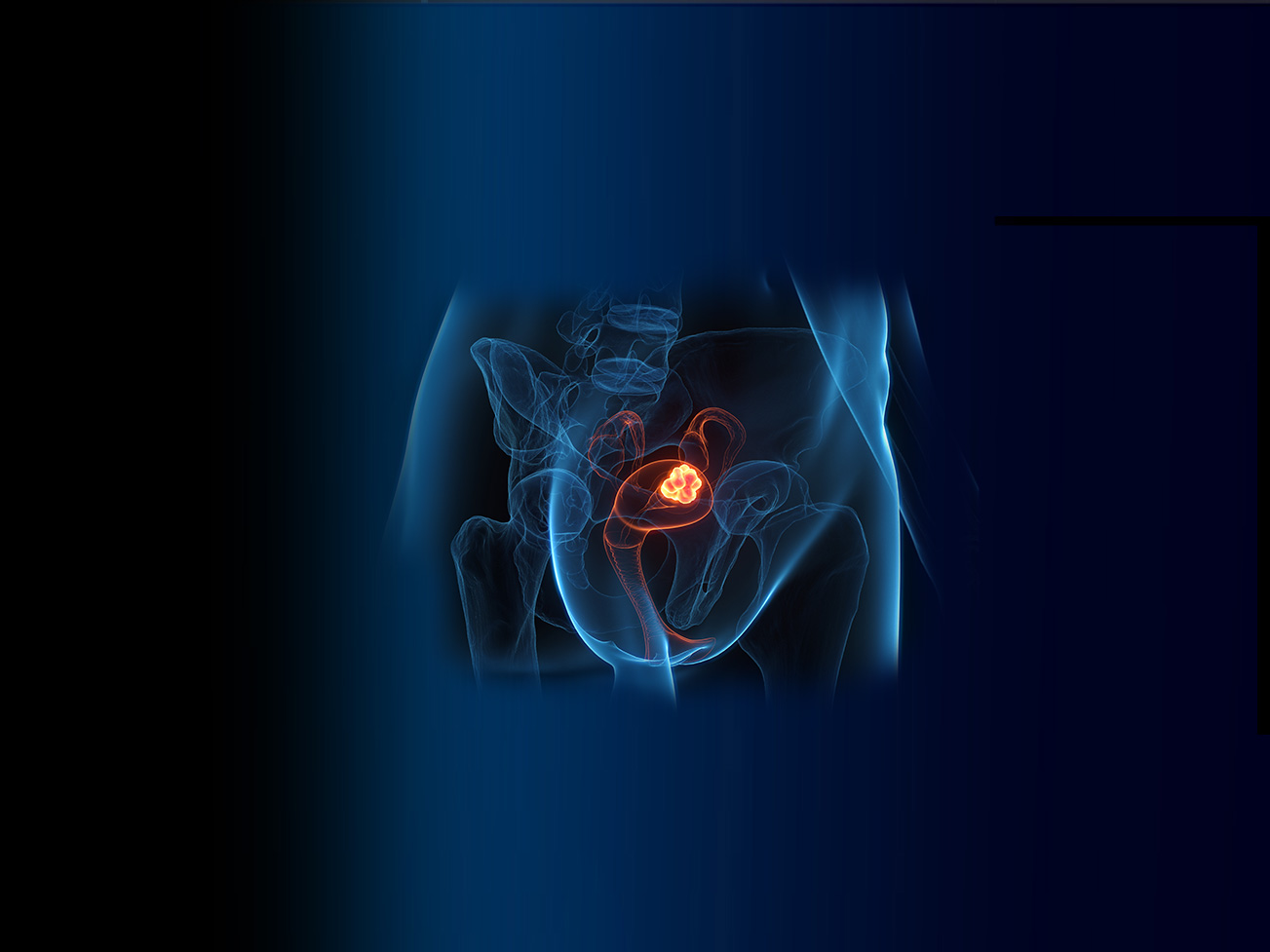 Chirurgie pelvienne et canc&eacute;rologique