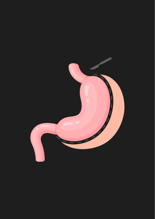 sleeve gastrique